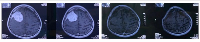 脑瘤手术前后的核磁共振成像（MRI）对比图。 