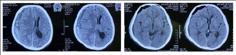 脑创伤手术前后的计算机断层扫描（CT Scan）对比图。 
